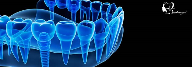 کشیدن دندان و ایمپلنت فوری